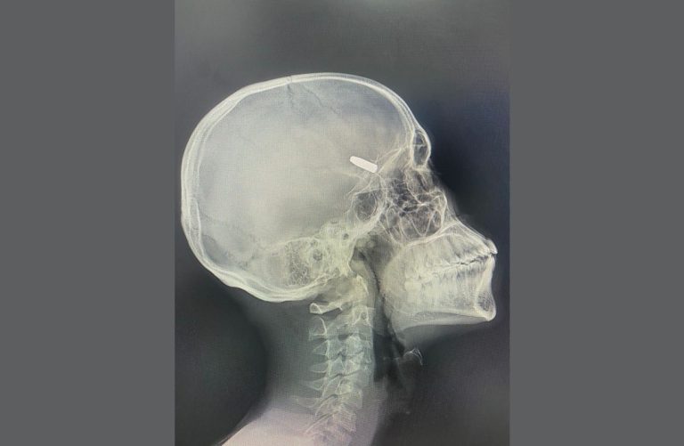 Extraction réussie d&rsquo;une balle logée dans la tête d&rsquo;un patient au CHTT/CNSS
